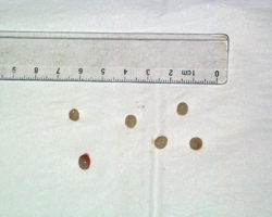 kidney stones